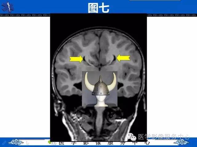 【影像征象】麋鹿头征and头盔征 ——胼胝体发育不全
