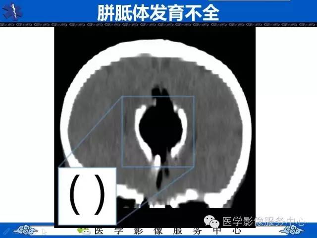 【影像征象】麋鹿头征and头盔征 ——胼胝体发育不全