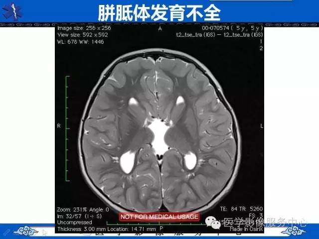 【影像征象】麋鹿头征and头盔征 ——胼胝体发育不全