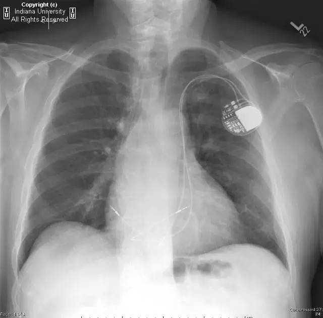 【病例】左侧上腔静脉1例