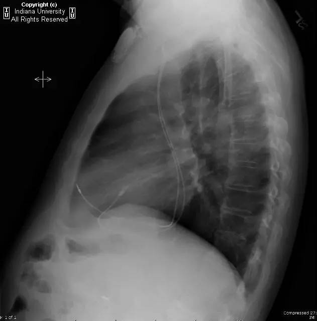 【病例】左侧上腔静脉1例