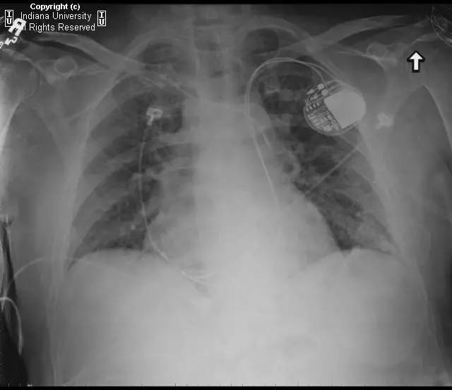 【病例】左侧上腔静脉1例