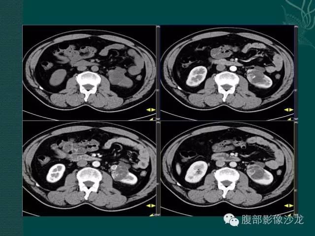 【病例】囊性肾癌1例CT及MR影像表现 【病例】囊性肾癌1例CT及MR影像表现