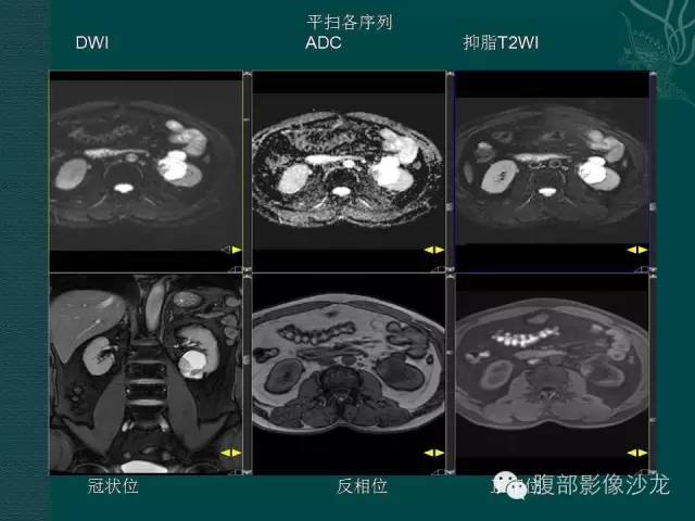 【病例】囊性肾癌1例CT及MR影像表现 【病例】囊性肾癌1例CT及MR影像表现