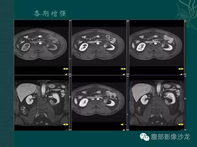 【病例】囊性肾癌1例CT及MR影像表现 【病例】囊性肾癌1例CT及MR影像表现