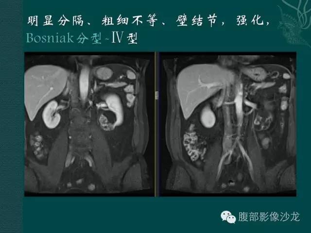 【病例】囊性肾癌1例CT及MR影像表现 【病例】囊性肾癌1例CT及MR影像表现