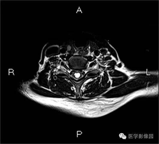 【病例】颈髓室管膜瘤1例MR影像表现 【病例】颈髓室管膜瘤1例MR影像表现