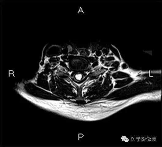 【病例】颈髓室管膜瘤1例MR影像表现 【病例】颈髓室管膜瘤1例MR影像表现