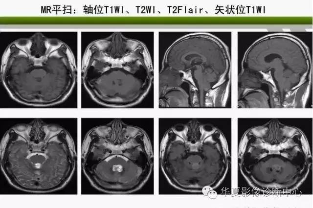 轻松掌握四脑室区5种肿瘤的影像诊断与鉴别诊断 轻松掌握四脑室区5种肿瘤的影像诊断与鉴别诊断