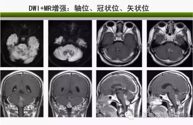 轻松掌握四脑室区5种肿瘤的影像诊断与鉴别诊断 轻松掌握四脑室区5种肿瘤的影像诊断与鉴别诊断