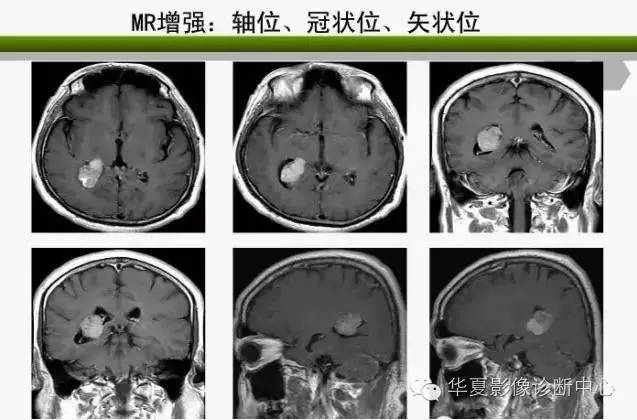 轻松掌握四脑室区5种肿瘤的影像诊断与鉴别诊断 轻松掌握四脑室区5种肿瘤的影像诊断与鉴别诊断