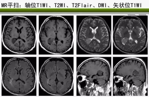 轻松掌握四脑室区5种肿瘤的影像诊断与鉴别诊断 轻松掌握四脑室区5种肿瘤的影像诊断与鉴别诊断