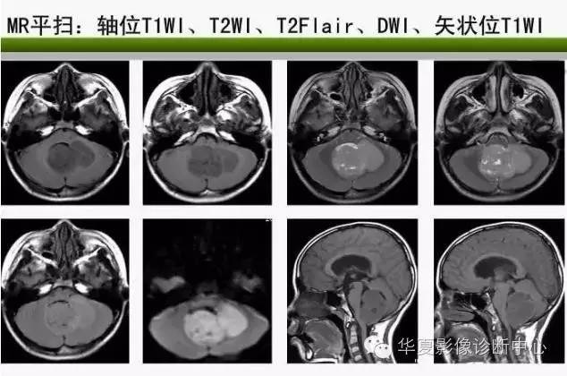 轻松掌握四脑室区5种肿瘤的影像诊断与鉴别诊断 轻松掌握四脑室区5种肿瘤的影像诊断与鉴别诊断