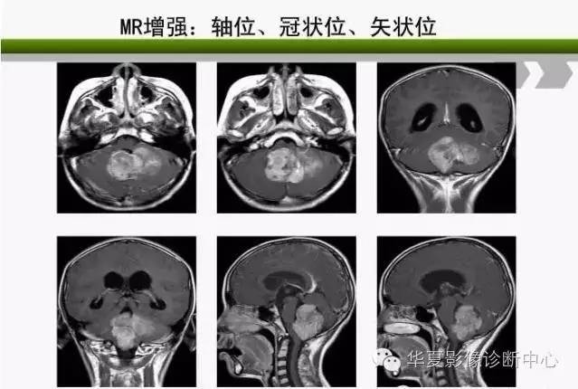 轻松掌握四脑室区5种肿瘤的影像诊断与鉴别诊断 轻松掌握四脑室区5种肿瘤的影像诊断与鉴别诊断