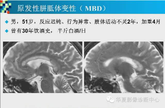 【PPT】胼胝体病变的MR诊断