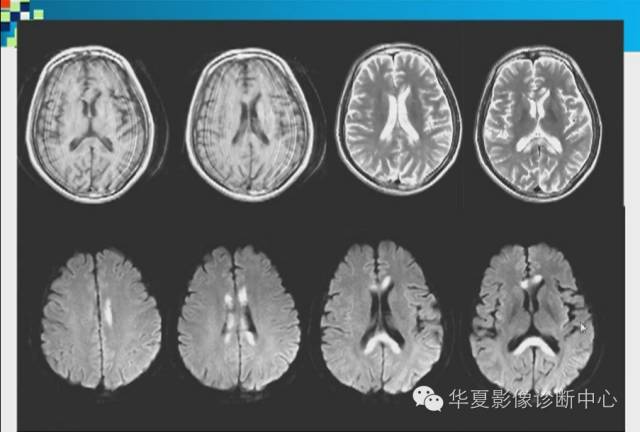 【PPT】胼胝体病变的MR诊断