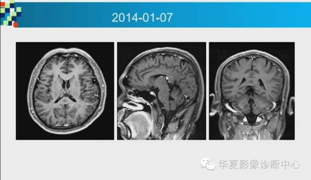【PPT】胼胝体病变的MR诊断