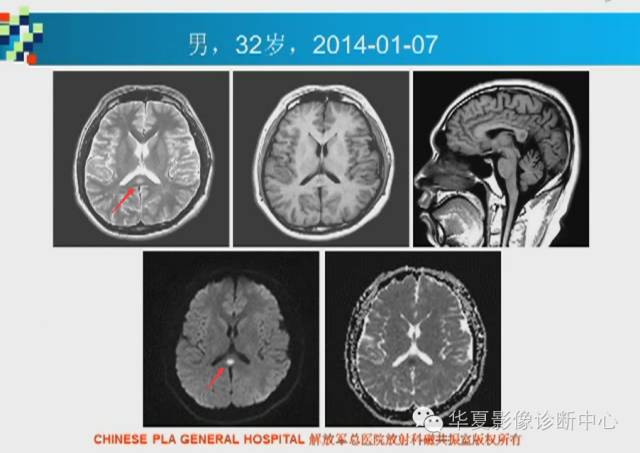 【PPT】胼胝体病变的MR诊断