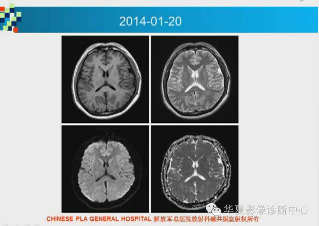 【PPT】胼胝体病变的MR诊断