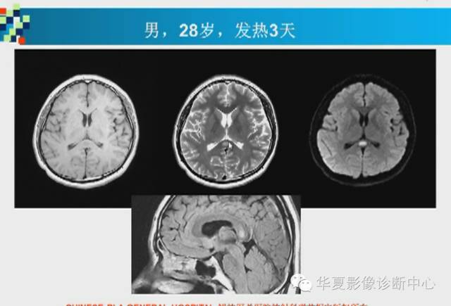 【PPT】胼胝体病变的MR诊断