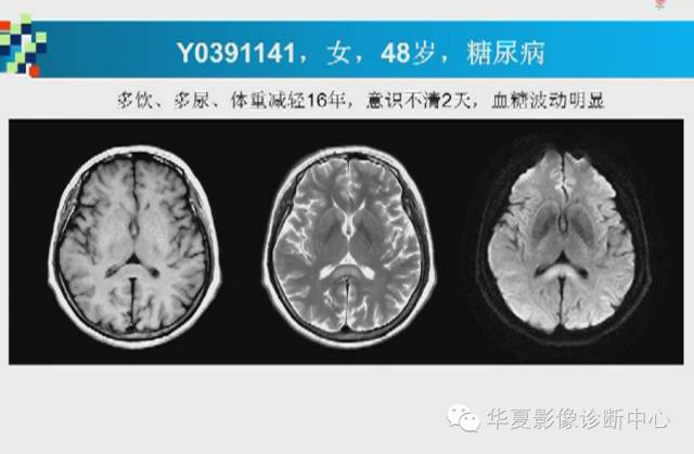 【PPT】胼胝体病变的MR诊断