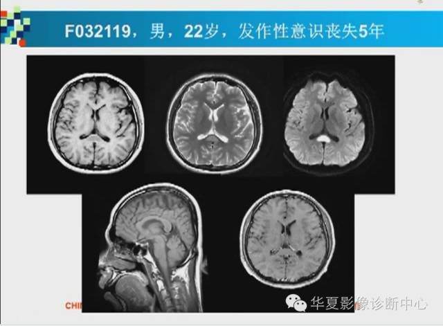 【PPT】胼胝体病变的MR诊断
