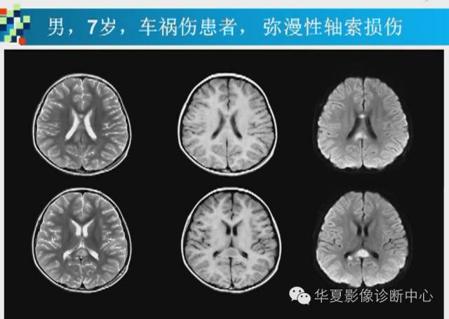 【PPT】胼胝体病变的MR诊断