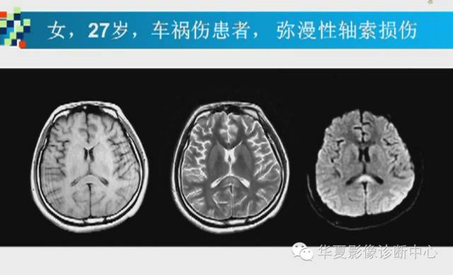 【PPT】胼胝体病变的MR诊断