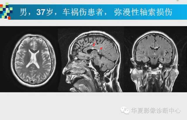 【PPT】胼胝体病变的MR诊断