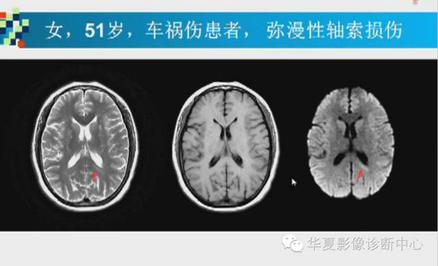 【PPT】胼胝体病变的MR诊断