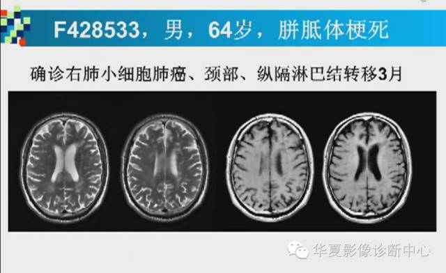 【PPT】胼胝体病变的MR诊断