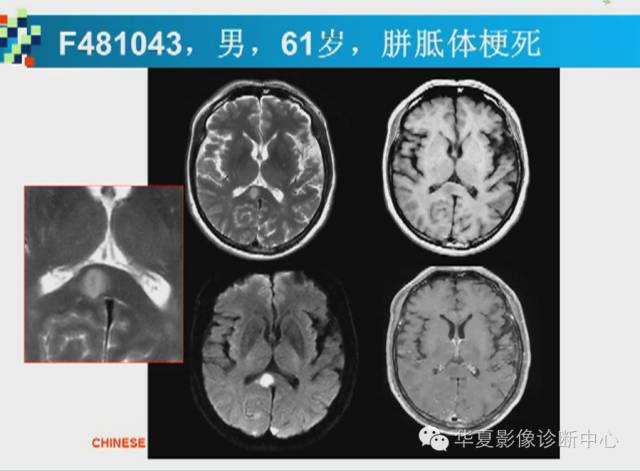 【PPT】胼胝体病变的MR诊断