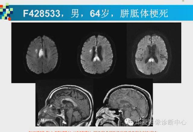 【PPT】胼胝体病变的MR诊断
