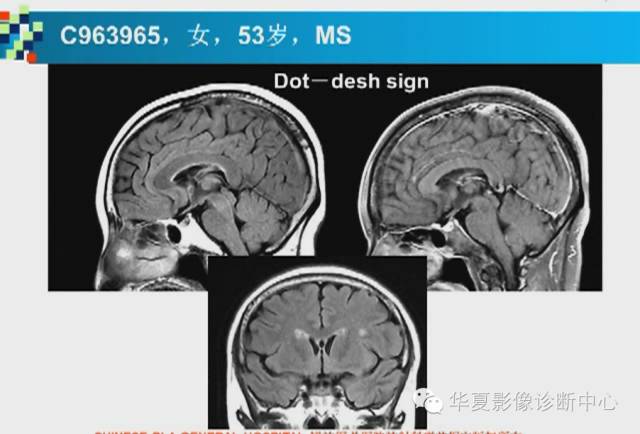 【PPT】胼胝体病变的MR诊断