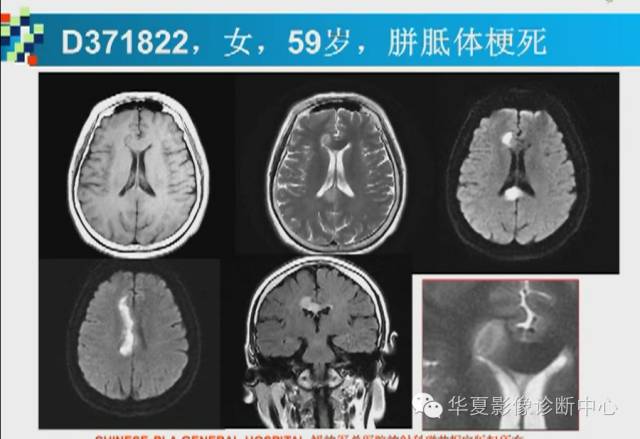 【PPT】胼胝体病变的MR诊断