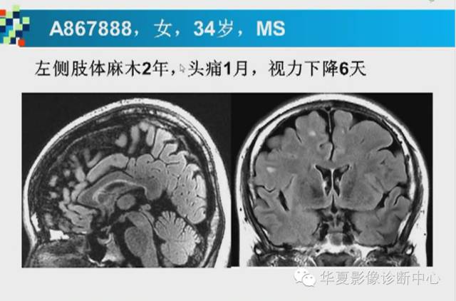 【PPT】胼胝体病变的MR诊断