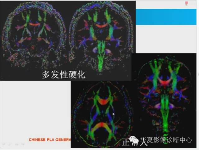 【PPT】胼胝体病变的MR诊断
