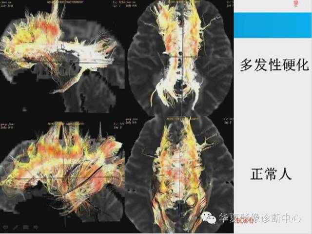 【PPT】胼胝体病变的MR诊断