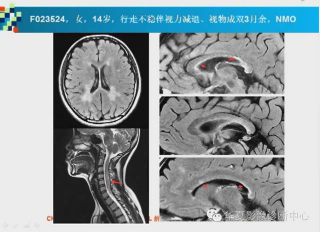 【PPT】胼胝体病变的MR诊断