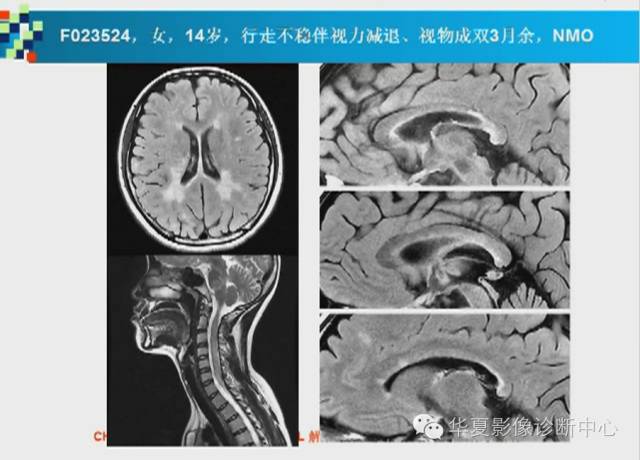 【PPT】胼胝体病变的MR诊断