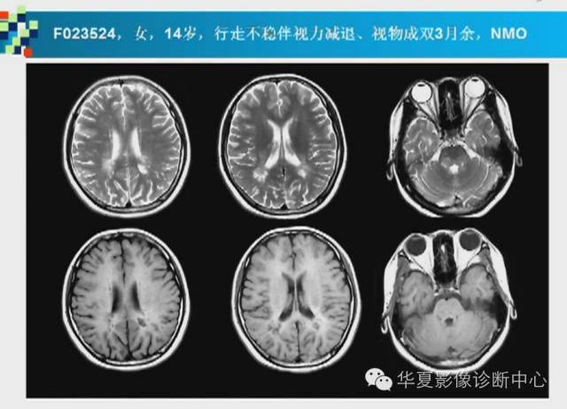 【PPT】胼胝体病变的MR诊断