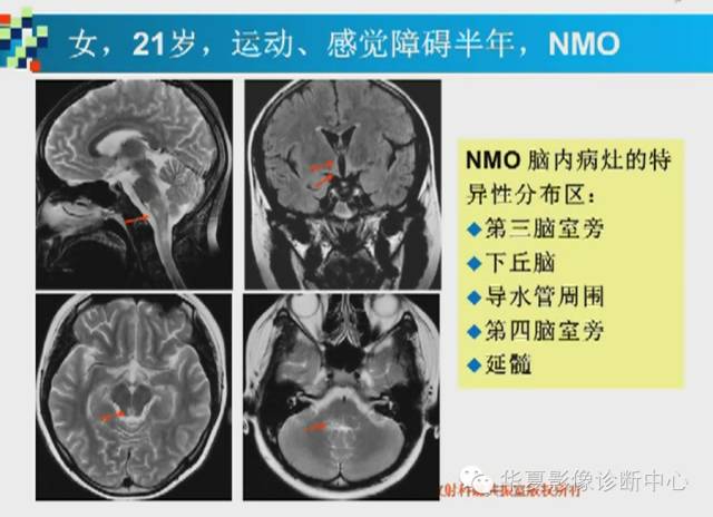 【PPT】胼胝体病变的MR诊断