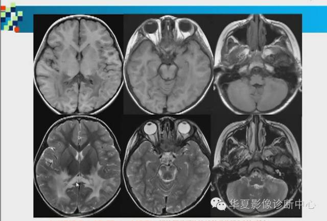 【PPT】胼胝体病变的MR诊断