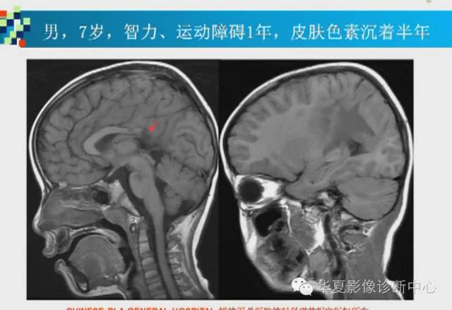 【PPT】胼胝体病变的MR诊断
