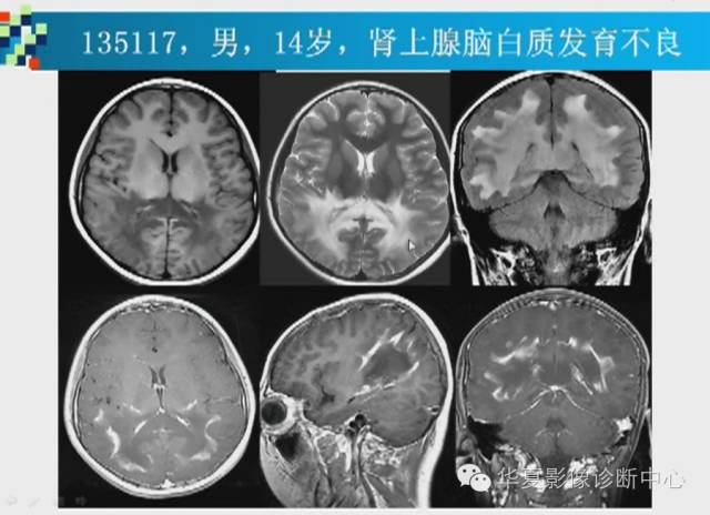 【PPT】胼胝体病变的MR诊断