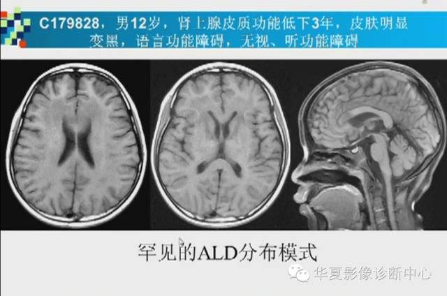 【PPT】胼胝体病变的MR诊断