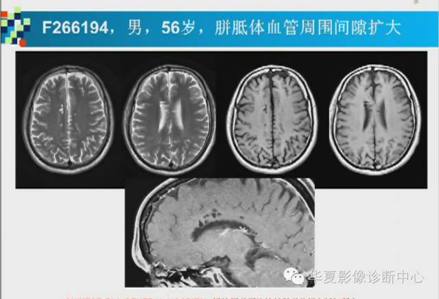 【PPT】胼胝体病变的MR诊断