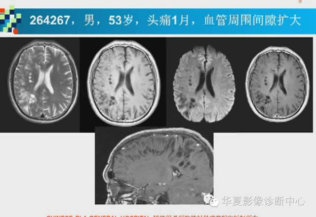【PPT】胼胝体病变的MR诊断