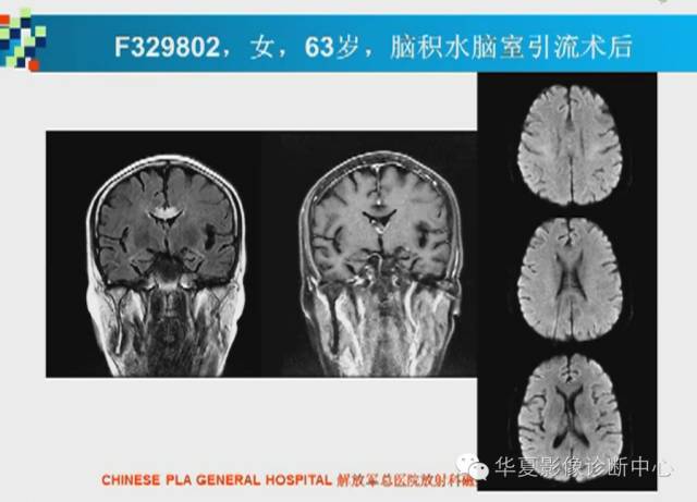 【PPT】胼胝体病变的MR诊断