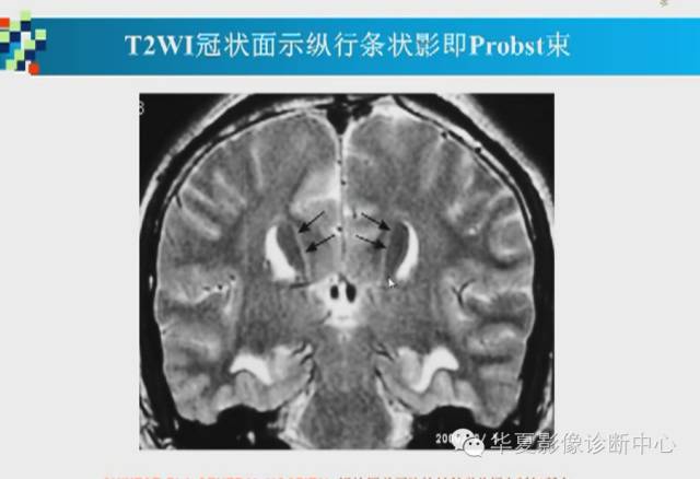 【PPT】胼胝体病变的MR诊断